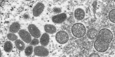 Macaé investiga suspeita de varíola dos macacos