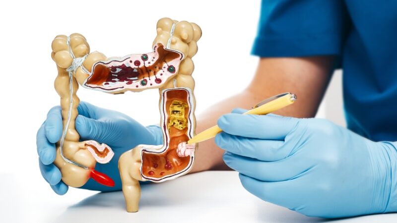 Rio terá programa de prevenção e tratamento ao câncer colorretal
